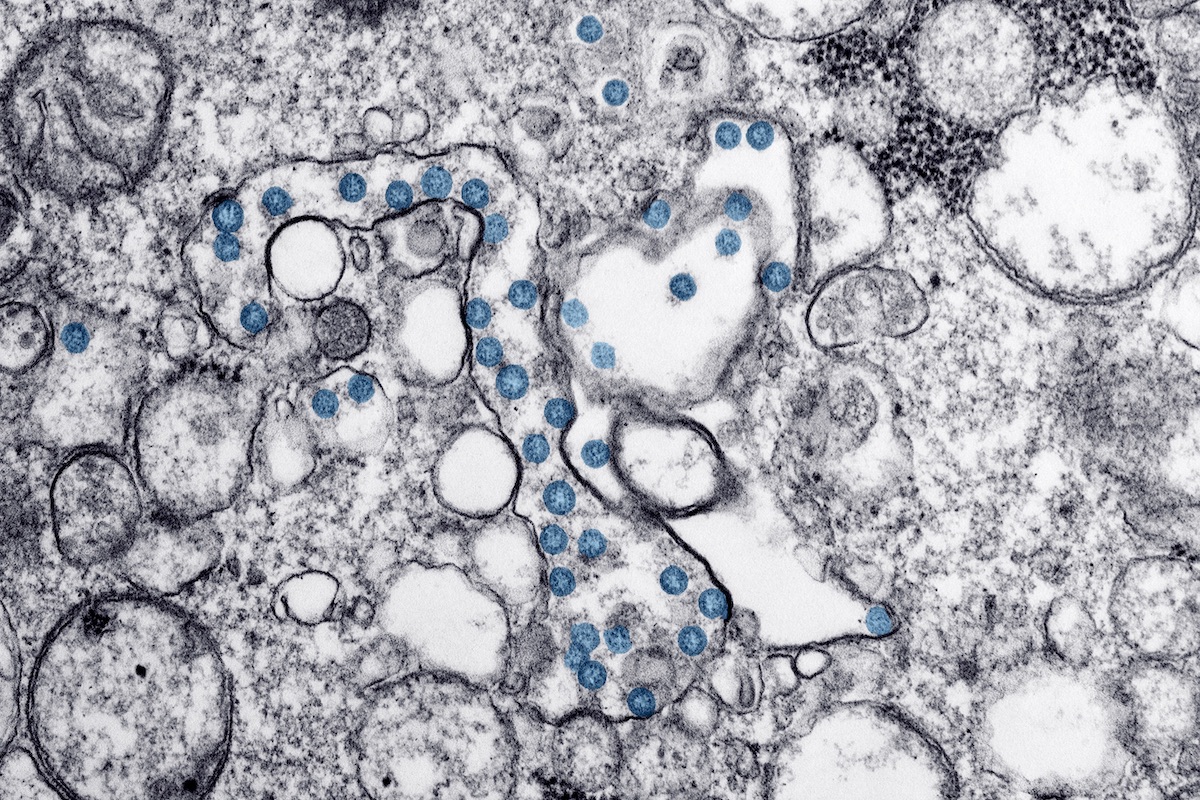 This is a transmission electron microscopic image of an isolate from the first US case of COVID-19, formerly known as 2019-nCoV. The spherical viral particles, colorized blue, contain cross-section through the viral genome, seen as black dots. [Image] Centers for Disease Control and Prevention (CDC.gov)